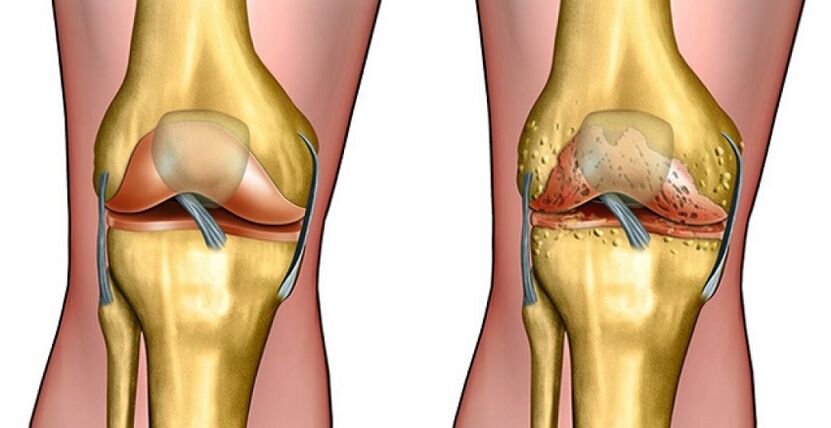 artroza kolana leczenie naturalne