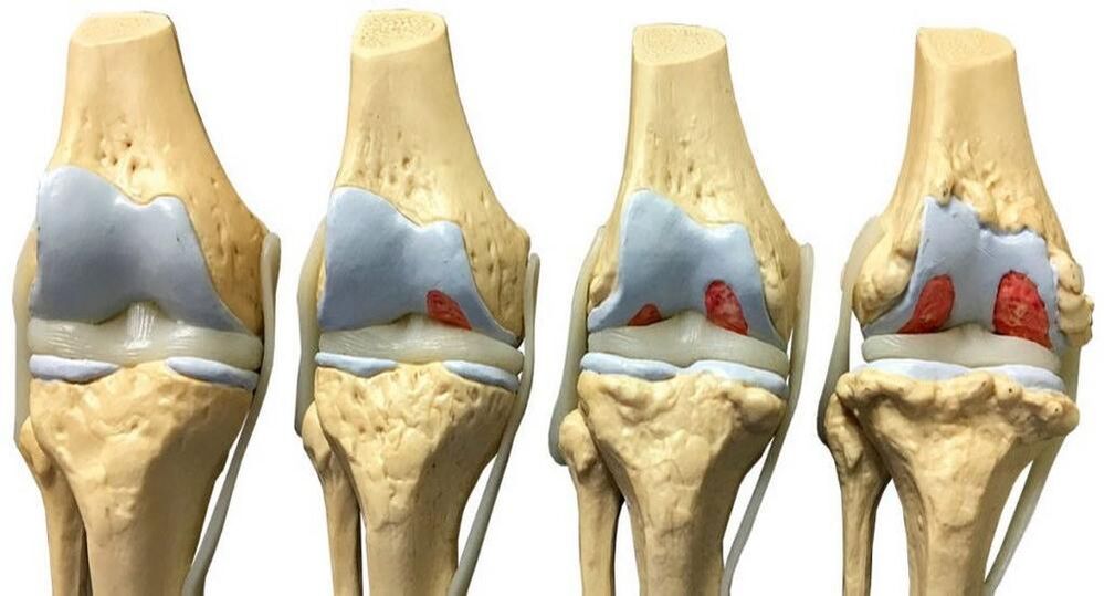 Etapy rozwoju artrozy stawu kolanowego