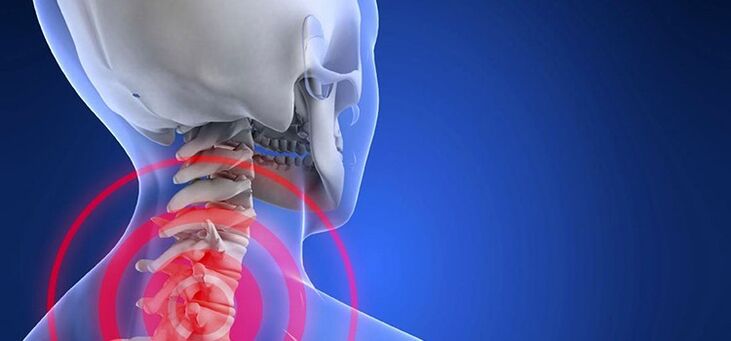 Osteochondroza odcinka szyjnego kręgosłupa